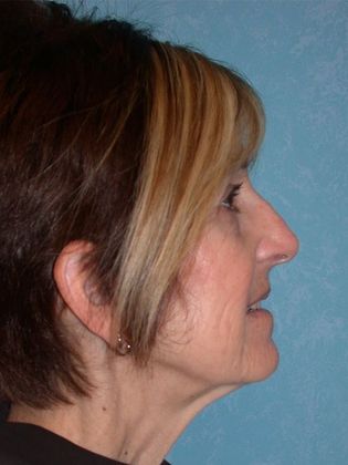 Face & Neck Lifts: FL1402 - Perrysburg, OH - Before