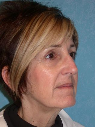 Face & Neck Lifts: FL1402 - Perrysburg, OH - Before