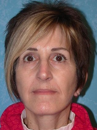 Face & Neck Lifts FL1402 - Perrysburg, OH - After