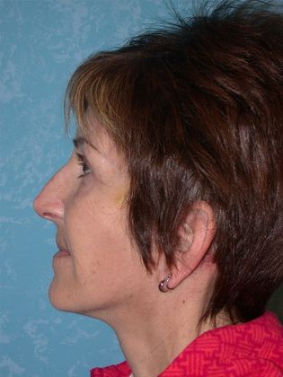 Face & Neck Lifts: FL1402 - Perrysburg, OH - After
