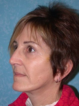 Face & Neck Lifts: FL1402 - Perrysburg, OH - After