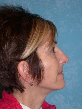 Face & Neck Lifts: FL1402 - Perrysburg, OH - After
