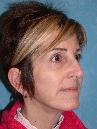 Face & Neck Lifts: FL1402 - Perrysburg, OH - After