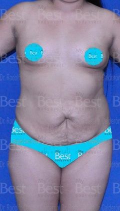 Mommy Makeover -Abdomen, Breast, Lipo, BBL-: Breast Augmentation + Tummy Tuck + Liposculpture with Brazilian Butt - Before