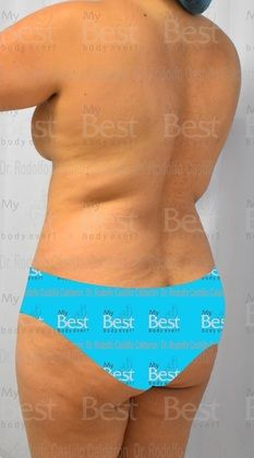 Mommy Makeover -Abdomen, Breast, Lipo, BBL-: Breast Augmentation + Tummy Tuck + Liposculpture with Brazilian Butt - Before