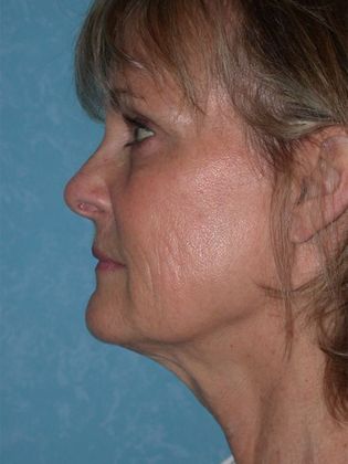 Face & Neck Lifts: FL1406 - Littleton, CO - Before