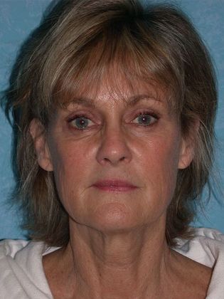 Face & Neck Lifts FL1406 - Littleton, CO - Before