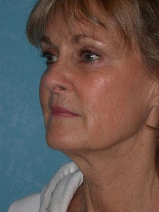 Face & Neck Lifts: FL1406 - Littleton, CO - Before