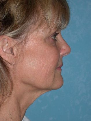 Face & Neck Lifts: FL1406 - Littleton, CO - Before