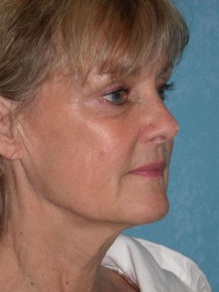 Face & Neck Lifts: FL1406 - Littleton, CO - Before