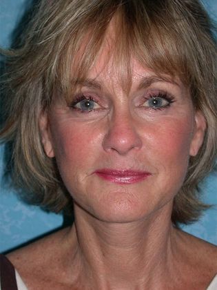 Face & Neck Lifts FL1406 - Littleton, CO - After