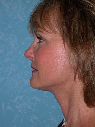 Face & Neck Lifts: FL1406 - Littleton, CO - After