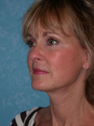 Face & Neck Lifts: FL1406 - Littleton, CO - After
