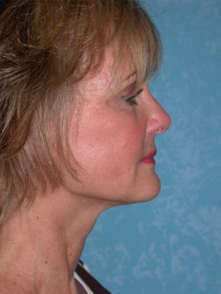 Face & Neck Lifts: FL1406 - Littleton, CO - After