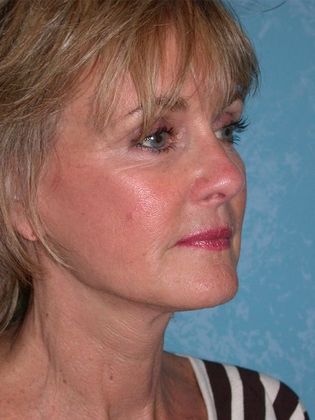 Face & Neck Lifts: FL1406 - Littleton, CO - After