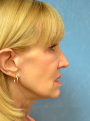 Face & Neck Lifts FL1409 - Toledo, OH - After