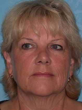 Face & Neck Lifts FL1415 - Sylvania, OH - Before