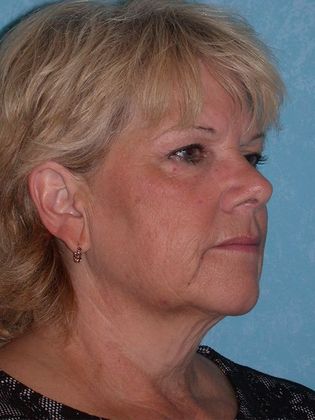 Face & Neck Lifts: FL1415 - Sylvania, OH - Before