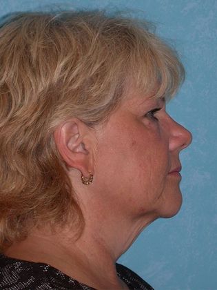 Face & Neck Lifts: FL1415 - Sylvania, OH - Before