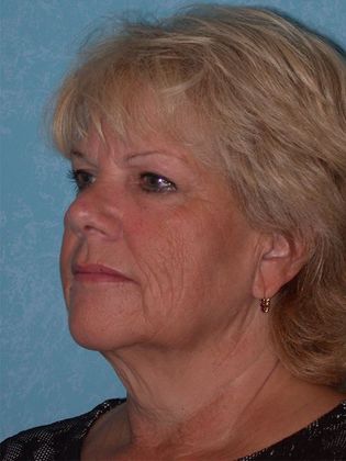 Face & Neck Lifts: FL1415 - Sylvania, OH - Before