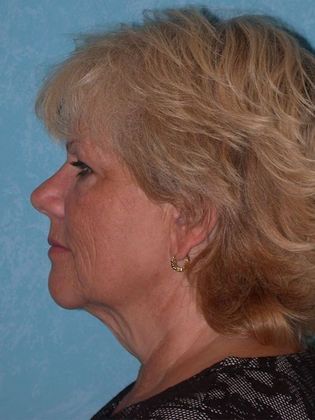 Face & Neck Lifts: FL1415 - Sylvania, OH - Before