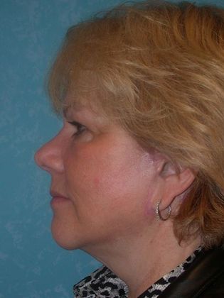 Face & Neck Lifts: FL1415 - Sylvania, OH - After