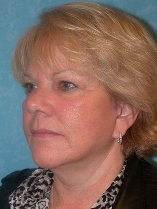Face & Neck Lifts: FL1415 - Sylvania, OH - After