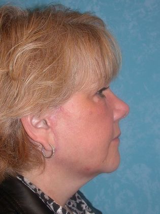 Face & Neck Lifts: FL1415 - Sylvania, OH - After