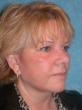 Face & Neck Lifts: FL1415 - Sylvania, OH - After