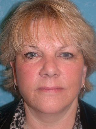 Face & Neck Lifts FL1415 - Sylvania, OH - After