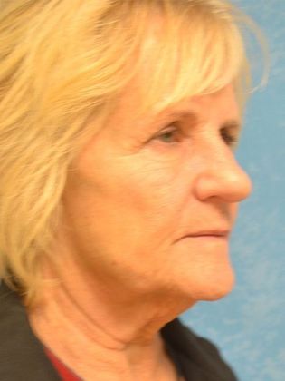 Face & Neck Lifts: FL1417 - Maumee, OH - Before