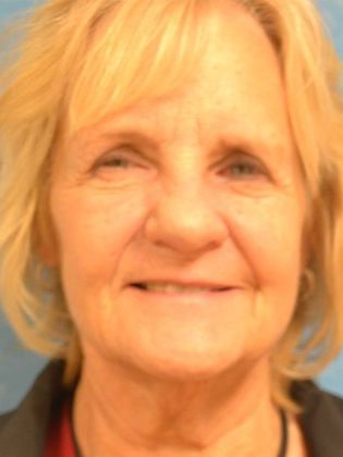 Face & Neck Lifts: FL1417 - Maumee, OH - Before