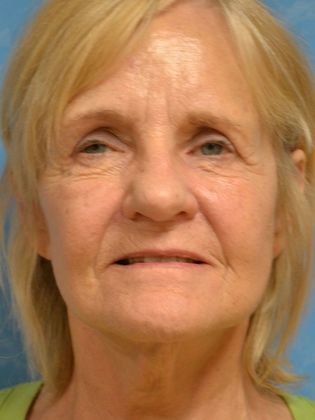 Face & Neck Lifts: FL1417 - Maumee, OH - After