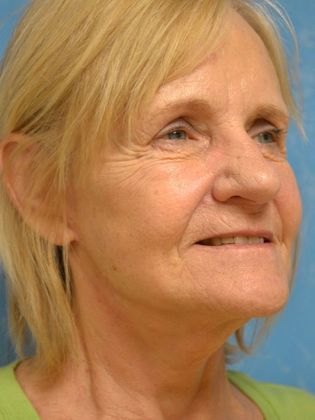 Face & Neck Lifts: FL1417 - Maumee, OH - After