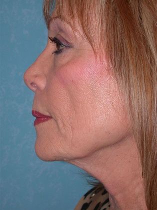 Face & Neck Lifts FL1523 - Sylvania, OH - Before