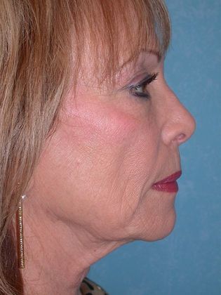 Face & Neck Lifts: FL1523 - Sylvania, OH - Before