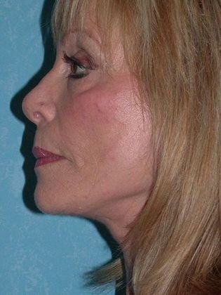 Face & Neck Lifts FL1523 - Sylvania, OH - After