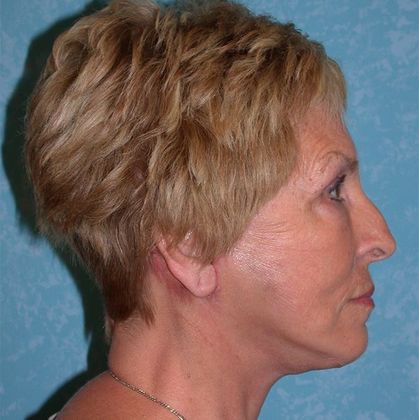 Face & Neck Lifts: FL1325 - Curtice, OH - After