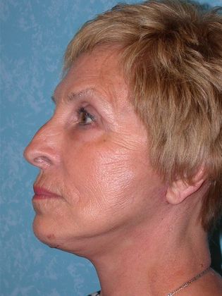 Face & Neck Lifts: FL1325 - Curtice, OH - After