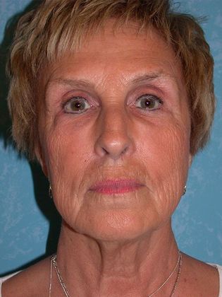 Face & Neck Lifts FL1325 - Curtice, OH - Before