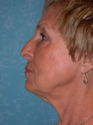 Face & Neck Lifts: FL1325 - Curtice, OH - Before