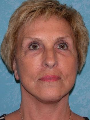 Face & Neck Lifts FL1325 - Curtice, OH - After