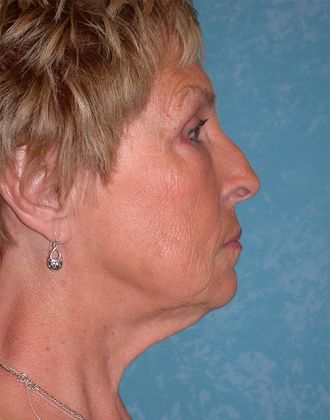Face & Neck Lifts: FL1325 - Curtice, OH - Before