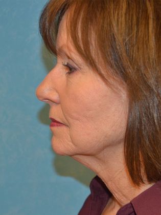 Face & Neck Lifts: Case 1327- Whitehouse, OH - Before