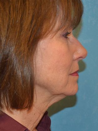 Face & Neck Lifts Case 1327- Whitehouse, OH - Before