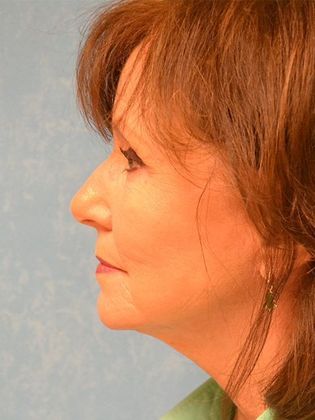 Face & Neck Lifts: Case 1327- Whitehouse, OH - After