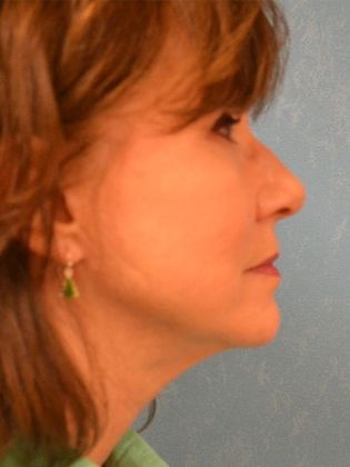 Face & Neck Lifts Case 1327- Whitehouse, OH - After