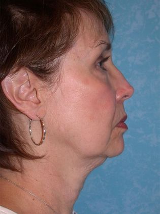 Face & Neck Lifts FL1431 - Ann Arbor, MI - Before