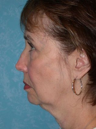 Face & Neck Lifts: FL1431 - Ann Arbor, MI - Before
