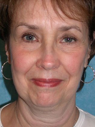 Face & Neck Lifts: FL1431 - Ann Arbor, MI - Before